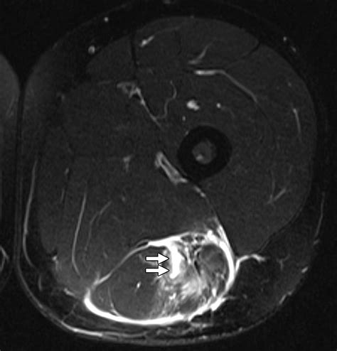 muscle tear mri scan